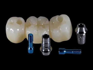 Implantatgetragene Kronen und Brücke mit Abutments und Schrauben - festsitzender Zahnersatz auf Implantaten.