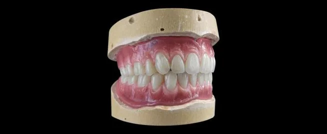 Totalprothese für einen zahnlosen Kiefer - zahnfleischfarbene Basis mit individuell aufgestellten Prothesenzähnen.