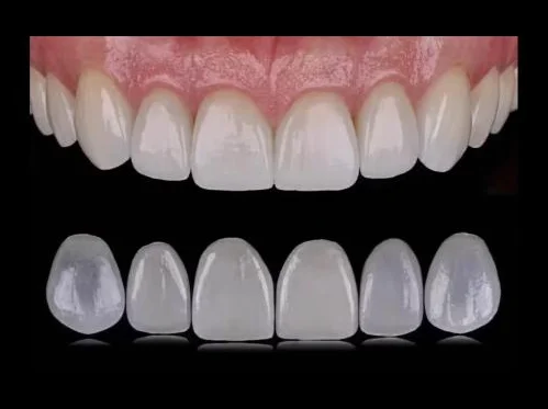 Keramik-Veneers auf den Frontzähnen - dünne Verblendschalen für eine natürliche, farbstabile Ästhetik.