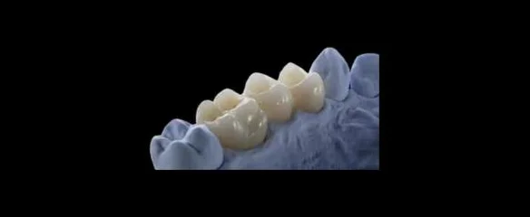 Monolithische Vollzirkon-Brücke aus Zirkonoxid auf einem Zahnmodell - metallfreier, hochbelastbarer Zahnersatz.