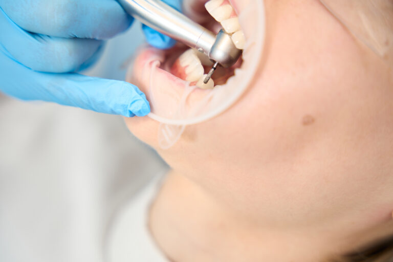 Zahnstein Entfernen Hausmittel Oder Zahnarzt | Topteeth 🦷 | Topteeth Zahnstein entfernen: Hausmittel oder Zahnarzt? | TopTeeth 🦷